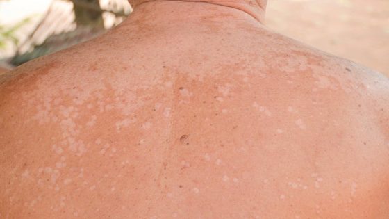 “النخالية المبرقشة” .. مرض جلدي يحتاج التخلص من الفطريات